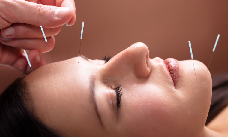 Origins-of-Acupuncture Close-up of a woman receiving facial acupuncture to support stress relief, balance, and skin rejuvenation at a wellness clinic.